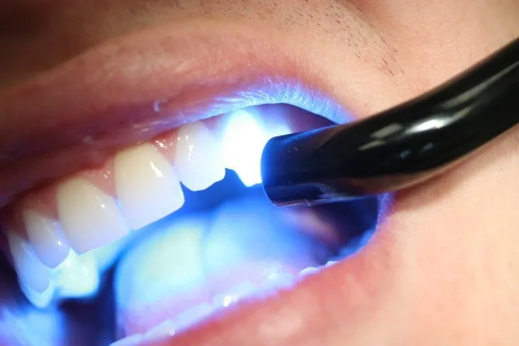 Curing light setting a tooth-coloured filling
