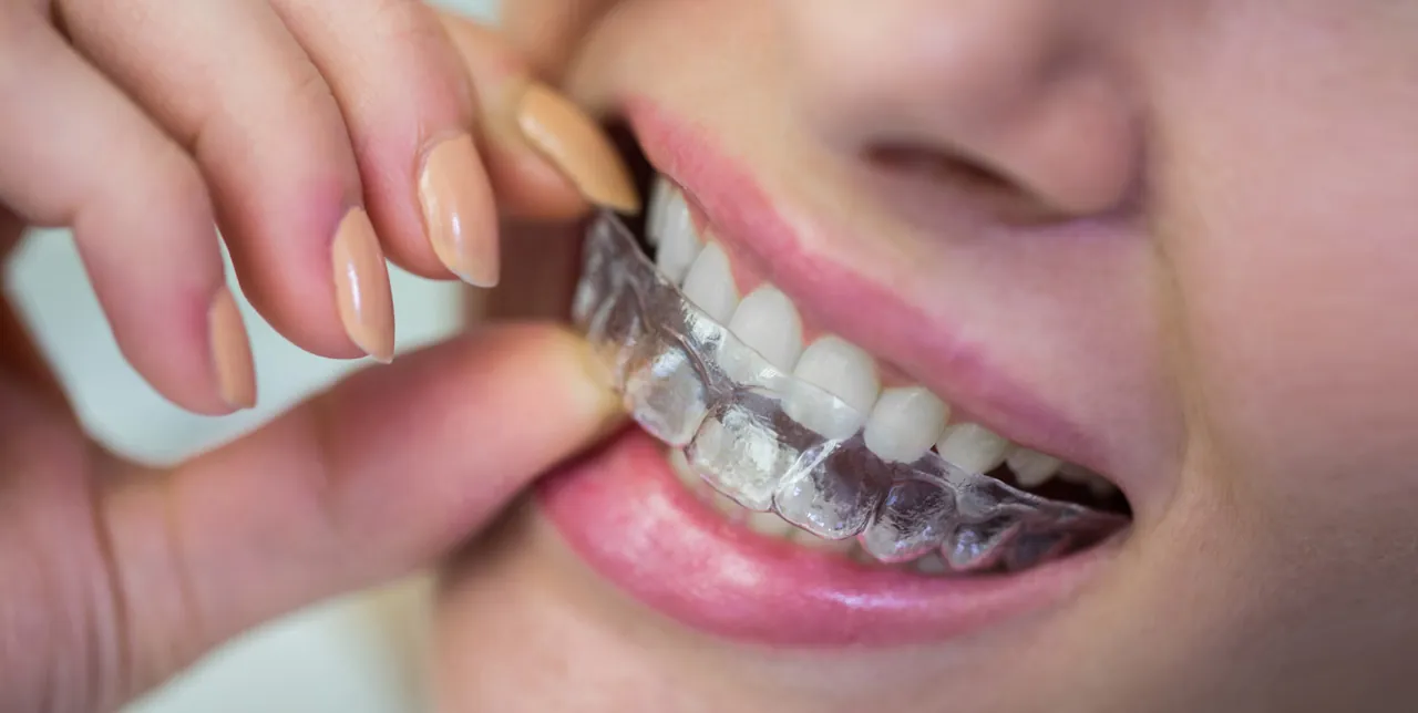 Clear aligner being fitted over the teeth