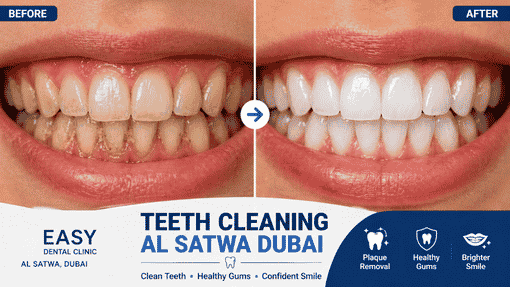 Benefits of Teeth Cleaning