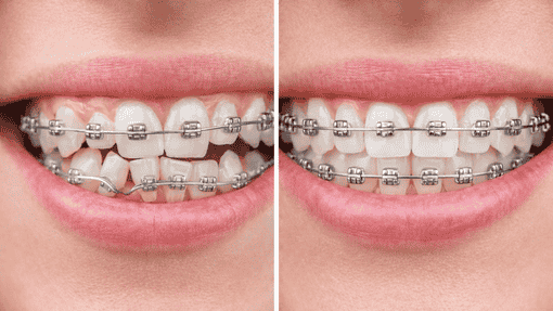 Why Choose Braces Treatment