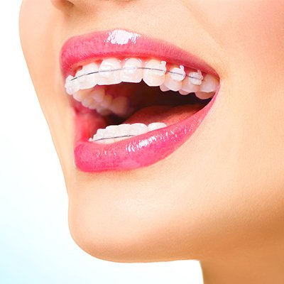 Metal Braces Dubai