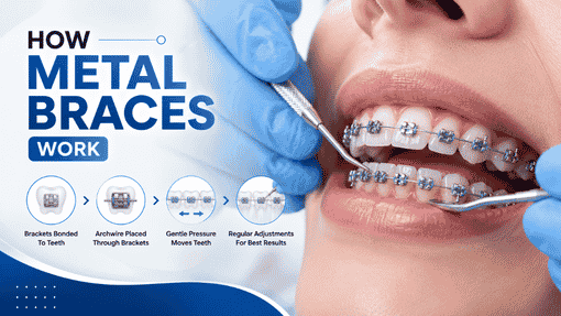 How Do Metal Braces Work