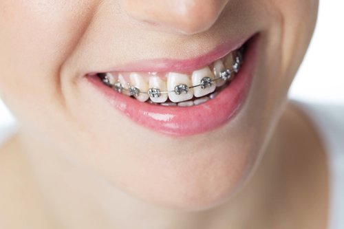 Ceramic Braces Dubai
