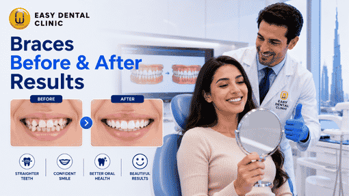 Ceramic Braces Dubai