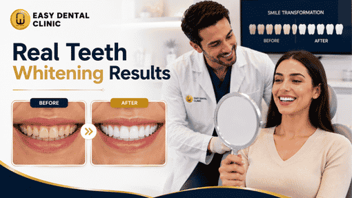 Whitening works best on natural teeth