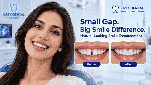 Tooth-colored Fillings Dubai